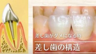 差し歯がダメになる時